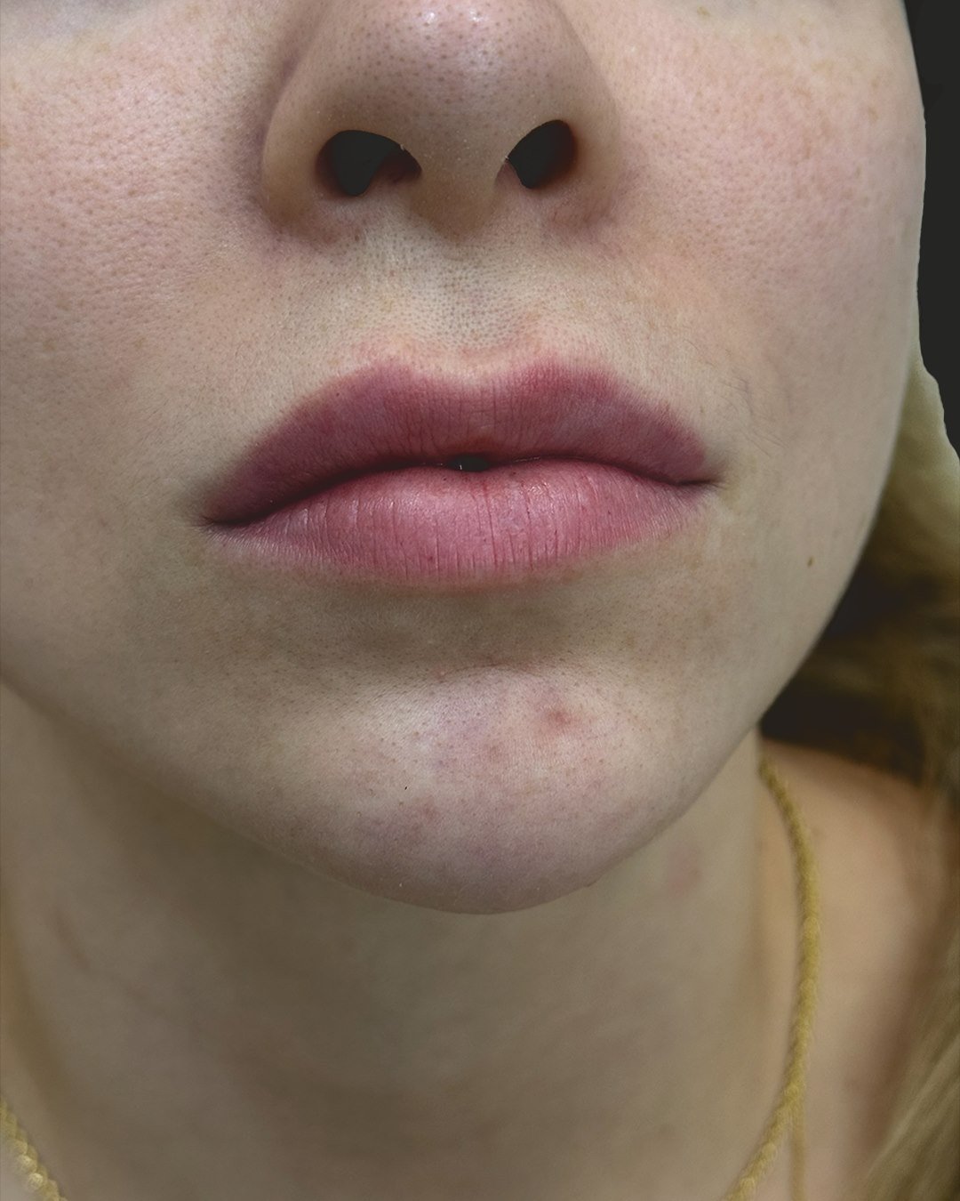 Antes do preenchimento labial: lábios com contorno pouco definido.