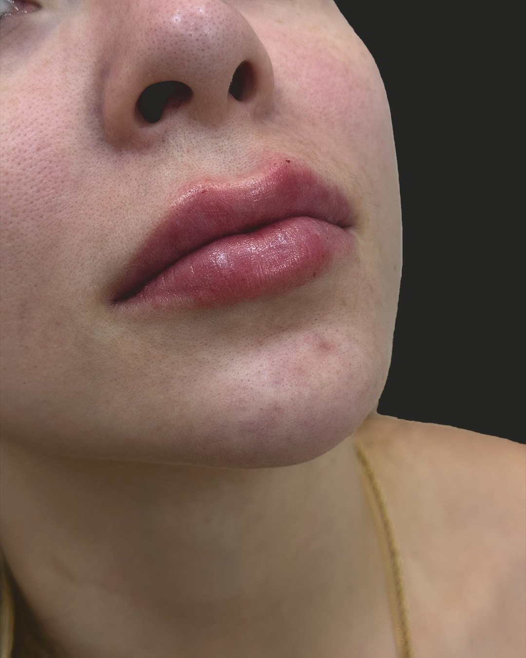 Depois do preenchimento labial: contorno definido e volume proporcional ao rosto.