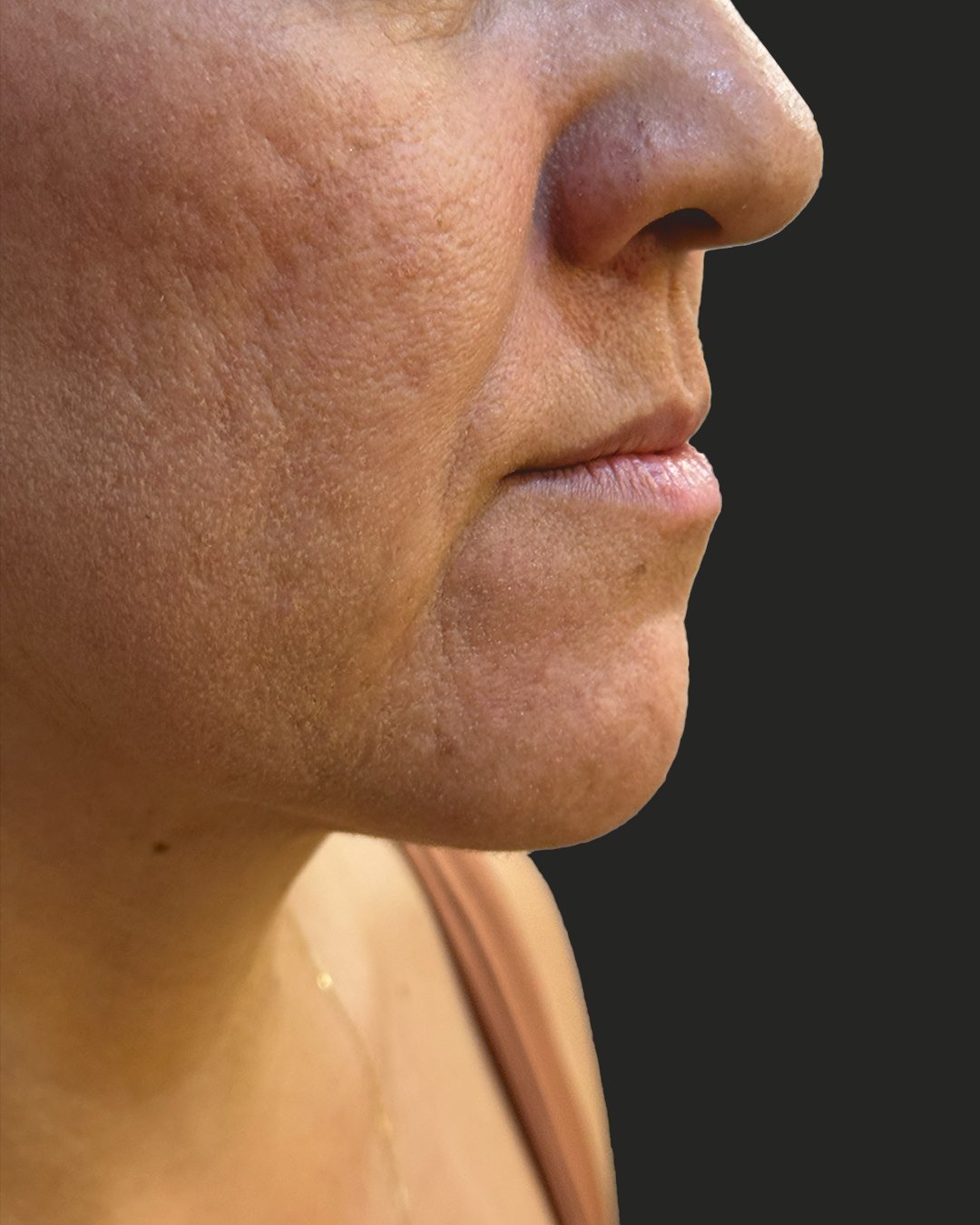 Antes do protocolo de rejuvenescimento: terço inferior do rosto com textura irregular.