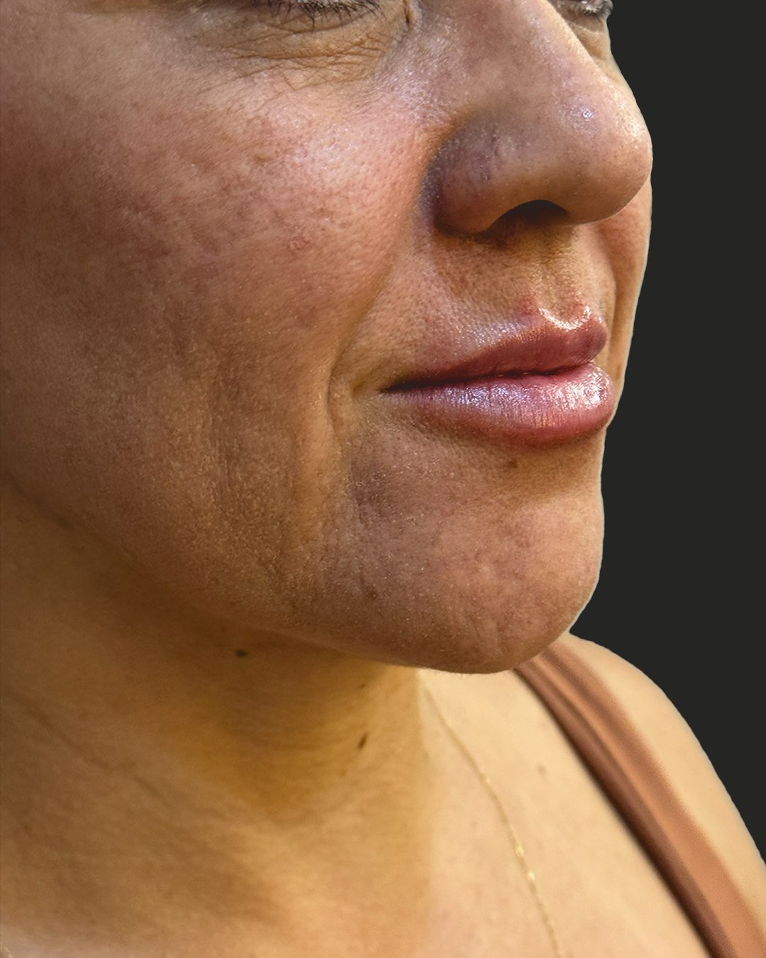 Depois do protocolo de rejuvenescimento: contorno mais definido e pele mais uniforme.