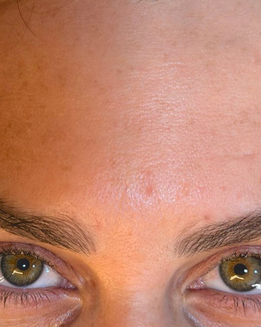Depois da toxina botulínica: testa lisa, com as sobrancelhas em posição natural.