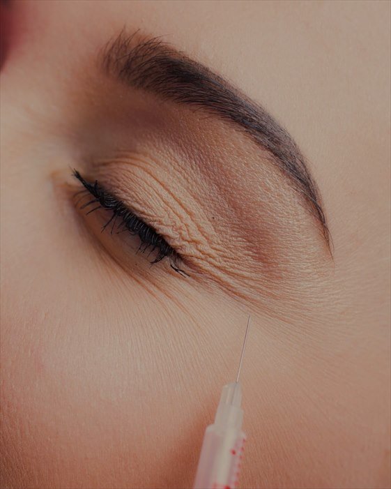 Close-up do contorno dos olhos de uma mulher, com agulha fina aproximando-se da região das linhas de expressão.
